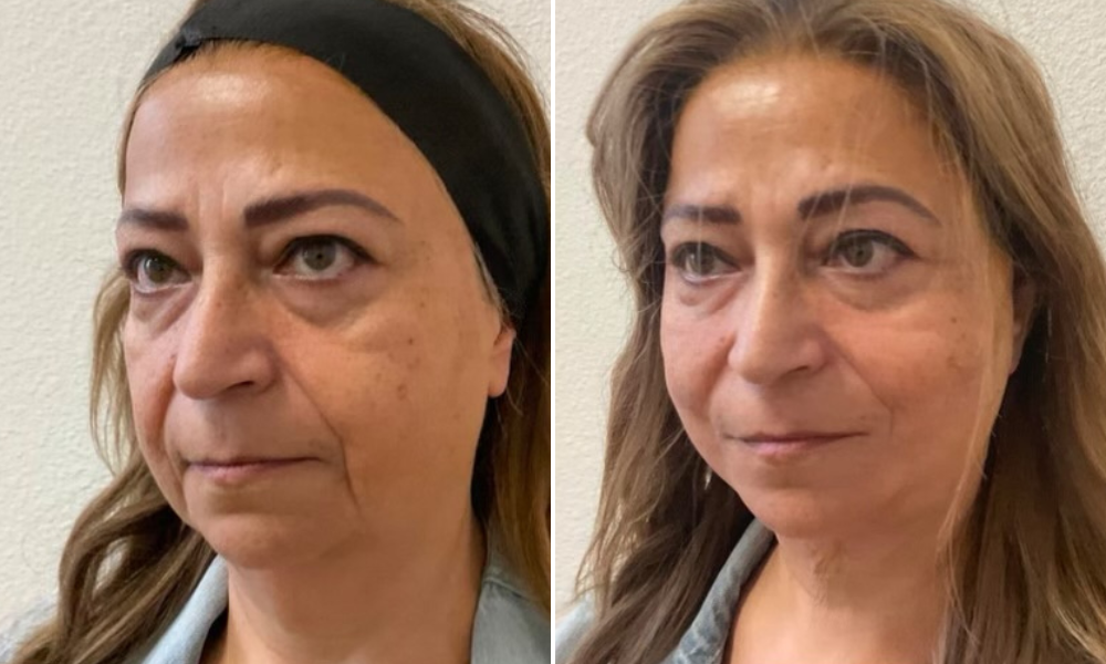 Before & After ThreadLift