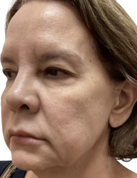 Microneedling case #2705