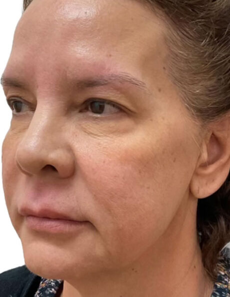 Microneedling case #2705