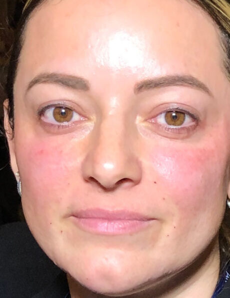 Dermal Fillers case #2717