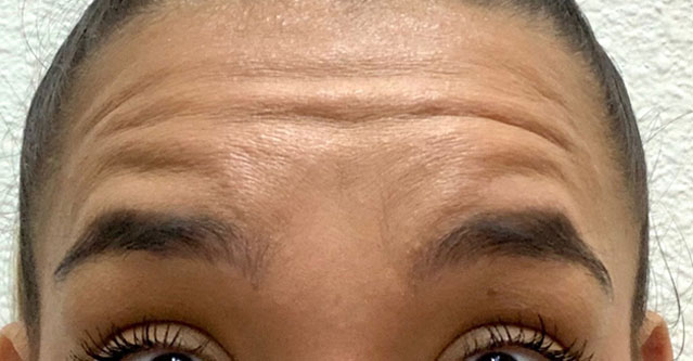 Untitled-2_0000_Botox.jpg copy
