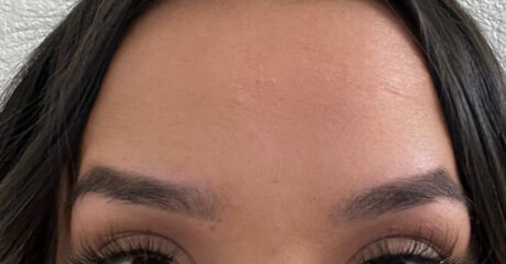 Botox case #2720