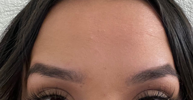 Untitled-2_0001_Botox.jpg