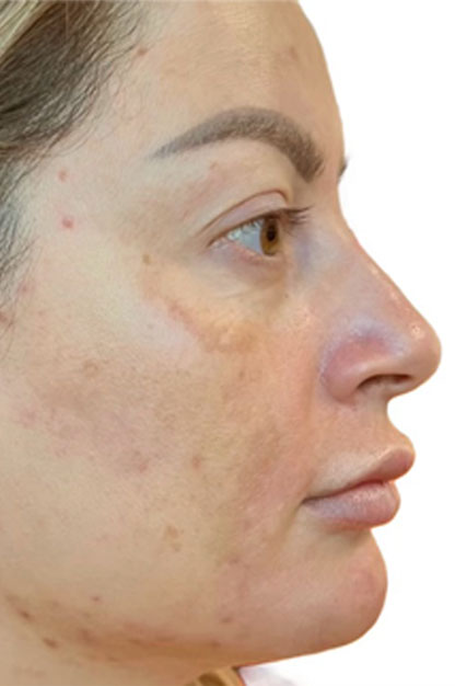 Pico Laser case #2708