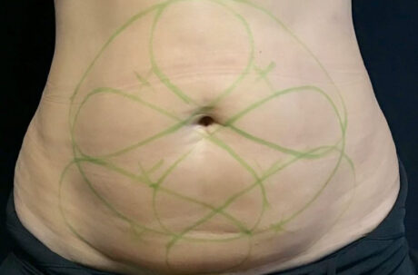 CoolSculpting case #2731