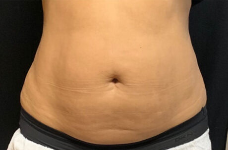 CoolSculpting case #2731