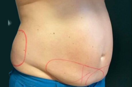 CoolSculpting case #2729