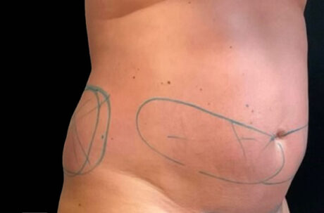 CoolSculpting case #2729