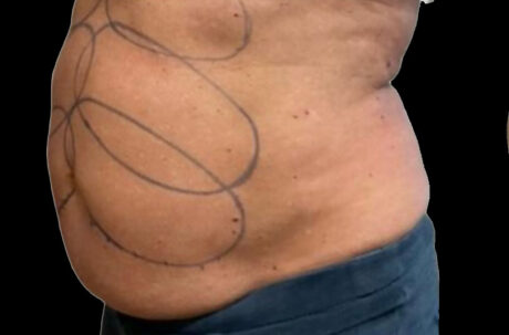 CoolSculpting case #2726