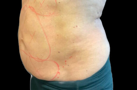 CoolSculpting case #2726