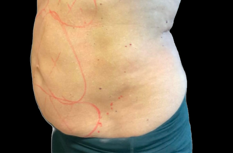 CoolSculpting case #2726