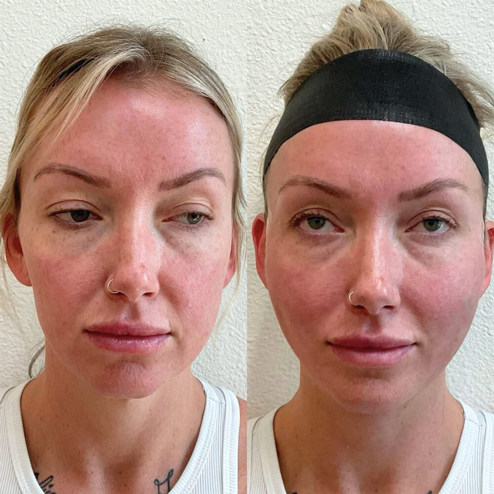 Threadlift case #2958