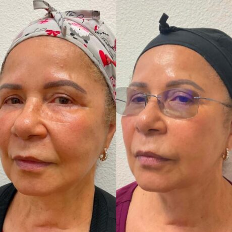 Threadlift case #2956
