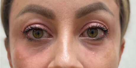 Dermal Fillers case #2960