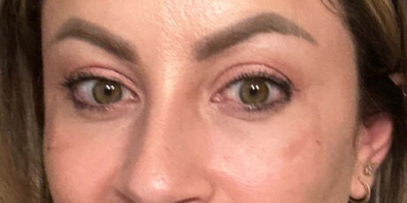 Dermal Fillers case #2960