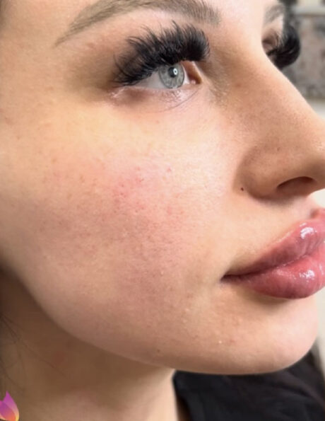 Dermal Fillers case #2963