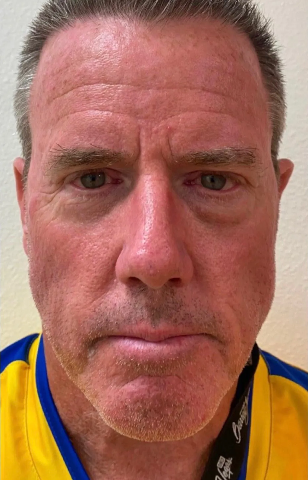sculptra-ba-after