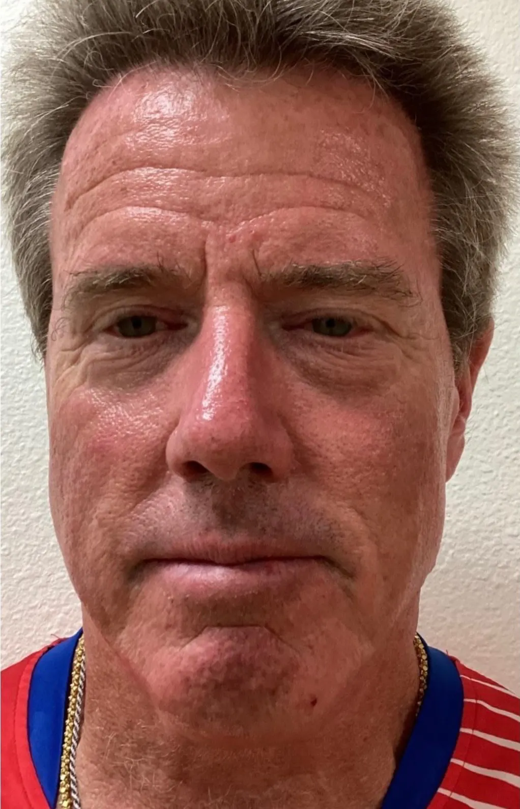 sculptra-ba-before